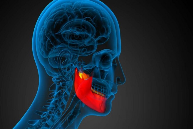 نوآوری های اسکلت بیرونی برای توانبخشی فک و دهان